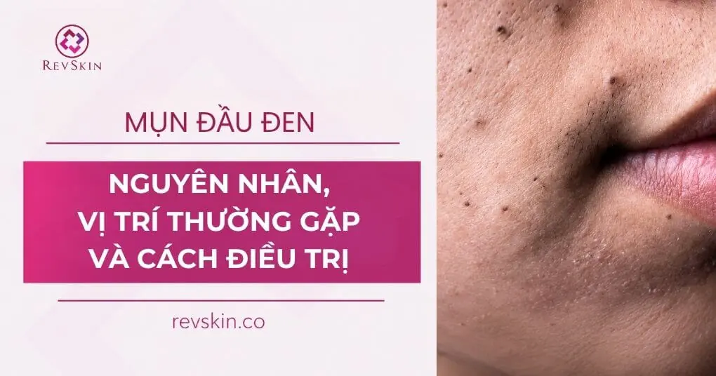 mụn đầu đen là gì