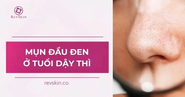 mụn đầu đen ở tuổi dậy thì