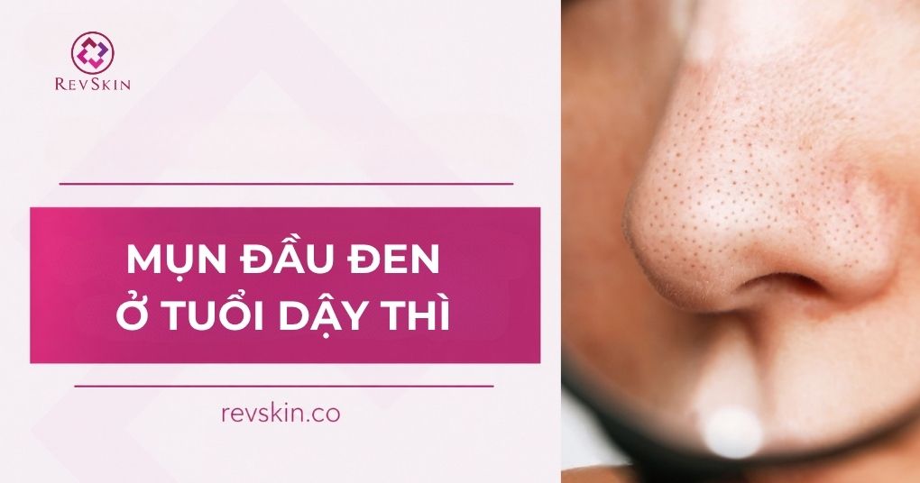 mụn đầu đen ở tuổi dậy thì