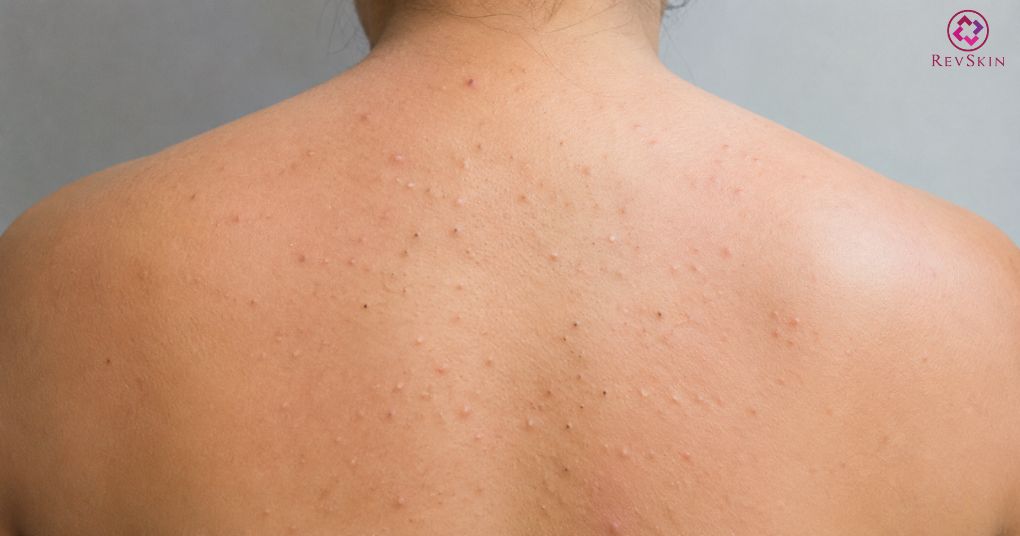 mụn đầu trắng đầu đen vùng lưng