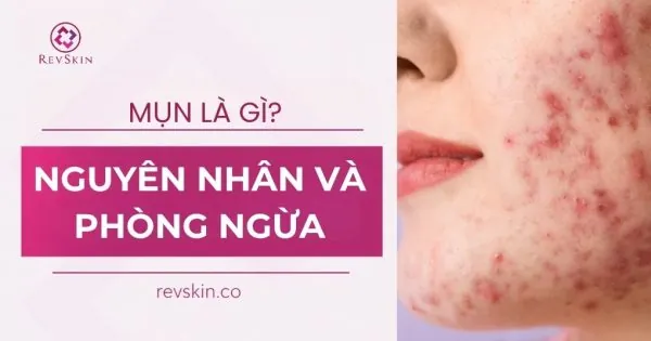 mụn là gì