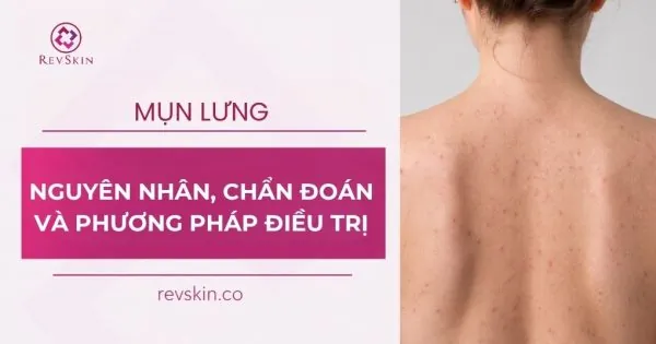 mụn lưng nguyên nhân cách điều trị