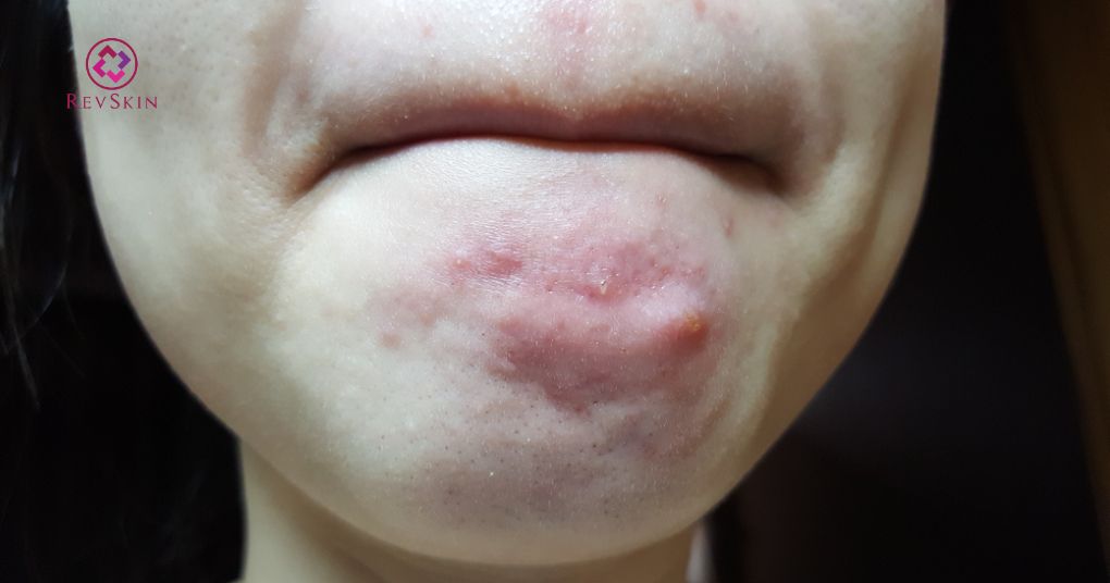 mụn nang hình thành và nguyên nhân