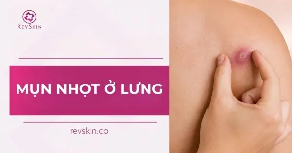 Mụn nhọt ở lưng là gì? Nguyên nhân, chẩn đoán và cách điều trị mụn nhọt ở lưng