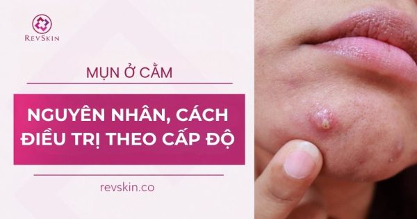 mụn ở cằm nguyên nhân cách điều trị