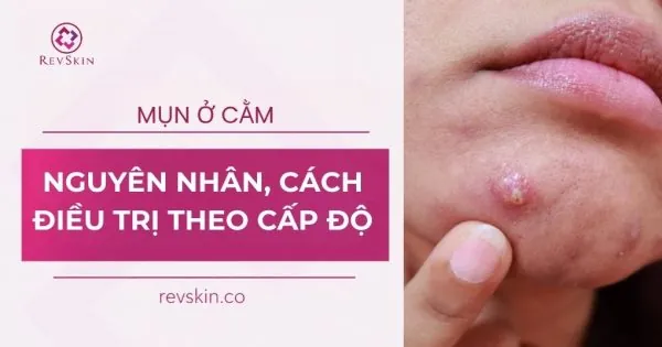 mụn ở cằm nguyên nhân cách điều trị