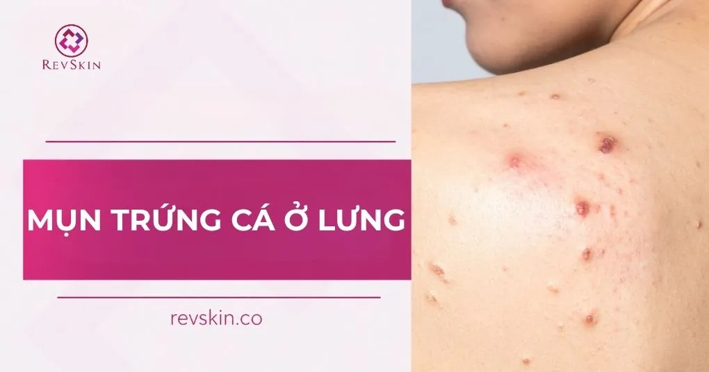 mụn trứng cá ở lưng
