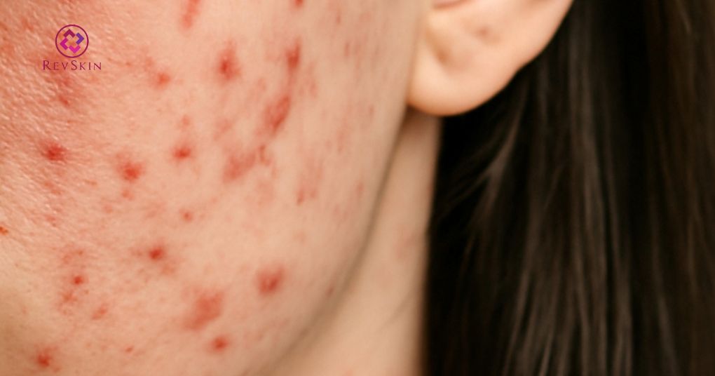 mụn viêm đỏ hình thành và nguyên nhân
