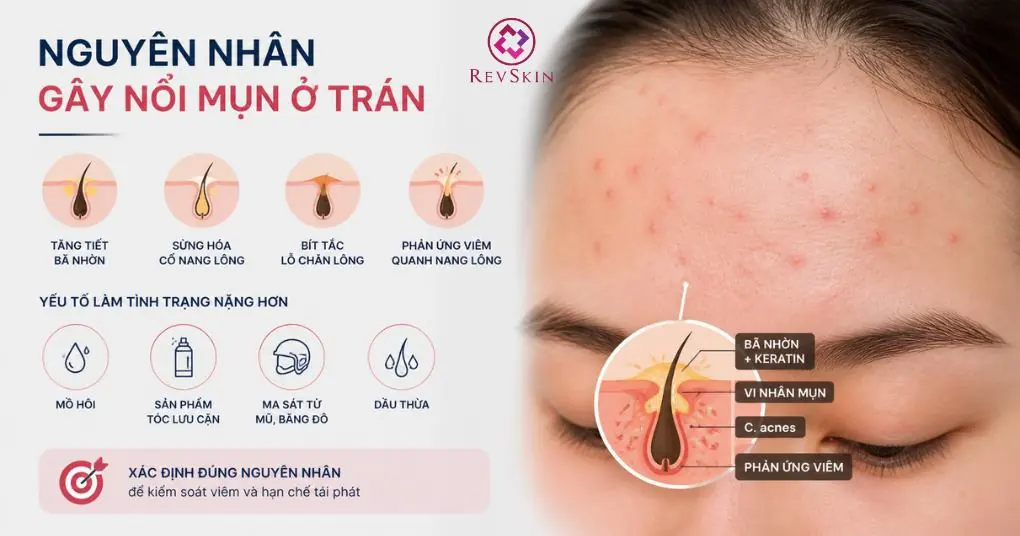 nguyên nhân và cơ chế gây mụn trán