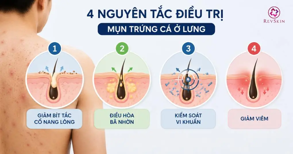 nguyên tắc điều trị mụn trứng cá lưng