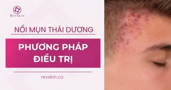 nổi mụn ở thái dương là do đâu