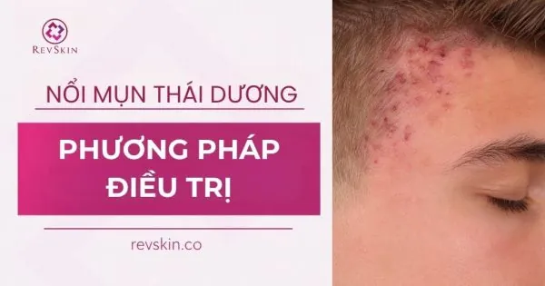 nổi mụn ở thái dương là do đâu