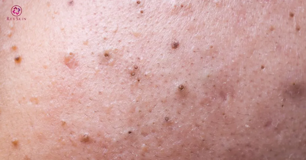 Mụn đầu đen ở tuổi dậy thì: Nguyên nhân, vị trí thường gặp và cách điều trị oxy hoá nhân mụn đầu đen