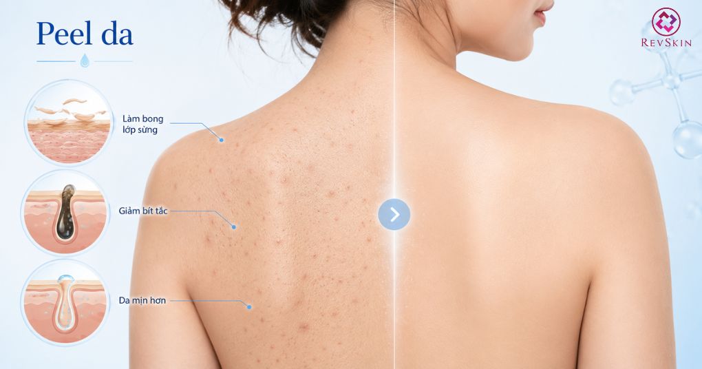 Mụn ẩn ở lưng: Nguyên nhân và cách điều trị chuẩn y khoa peel da giảm bít tắc cải thiện sần sùi