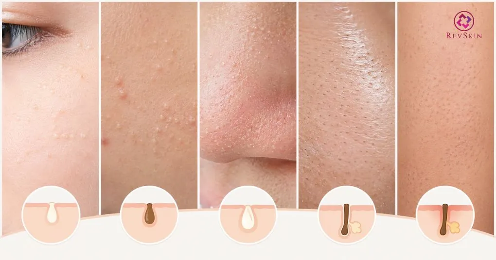 Cách trị mụn đầu trắng hiệu quả theo phác đồ y khoa phân biệt mụn đầu trắng