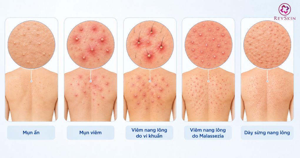 Mụn ẩn ở lưng: Nguyên nhân và cách điều trị chuẩn y khoa phân biệt mụn lưng và các tổn thương