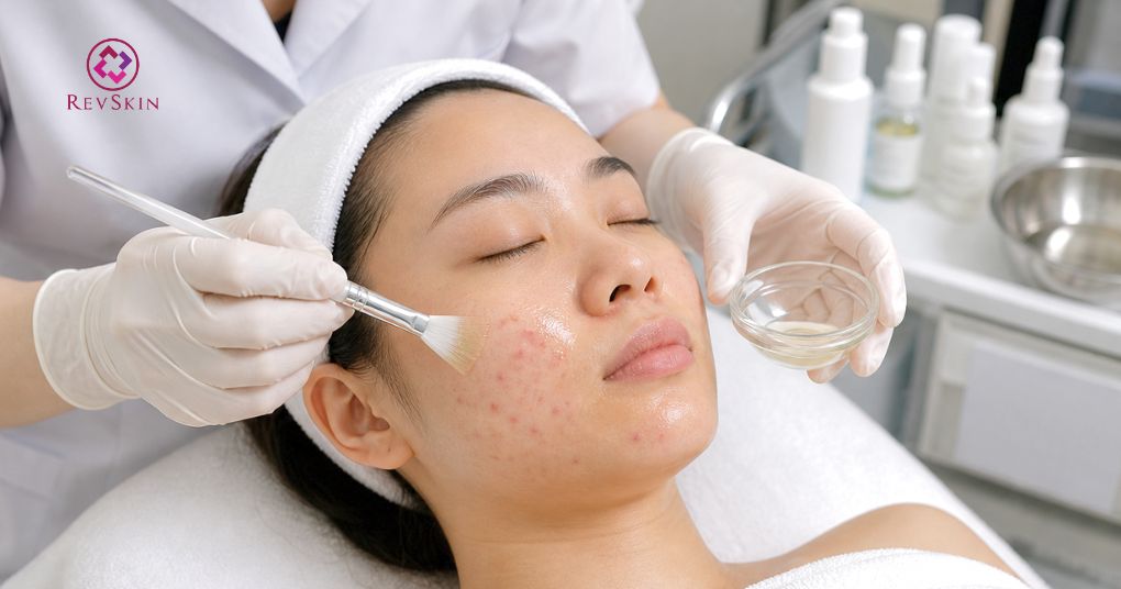 phương pháp điều trị mụn peel da hoá học
