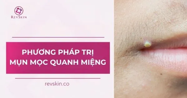 phương pháp trị mụn mọc quanh miệng