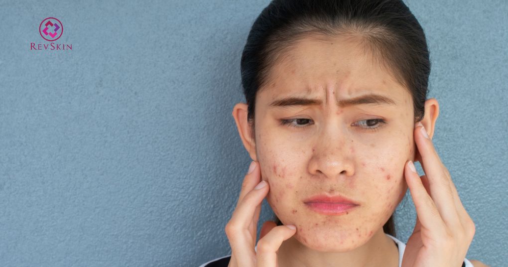 sai lầm đánh giá phân loại mụn
