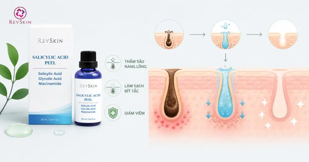 salicylic acid peel giảm bít tắc