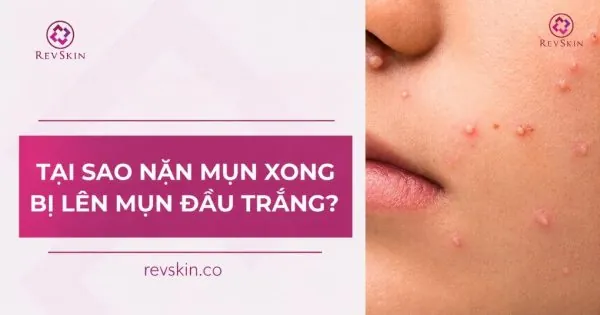 Nặn mụn xong bị lên mụn đầu trắng là do đâu? Hướng dẫn xử lý tại sao nặn mụn xong bị lên mụn đầu trắng