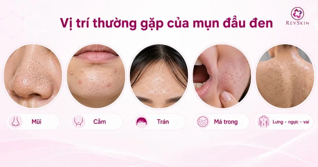 vị trí thường gặp của mụn đầu đen
