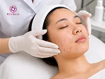 Điều trị mụn
