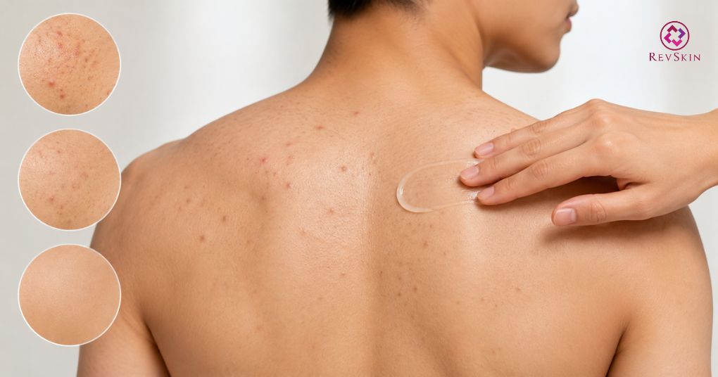 Trị thâm mụn lưng chuẩn y khoa giúp kiểm soát sắc tố sau viêm bôi thoa tại chỗ trị thâm mụn lưng