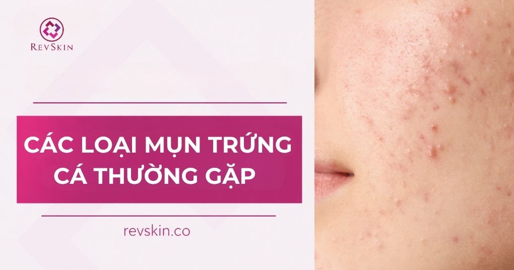 các loại mụn trứng cá thường gặp