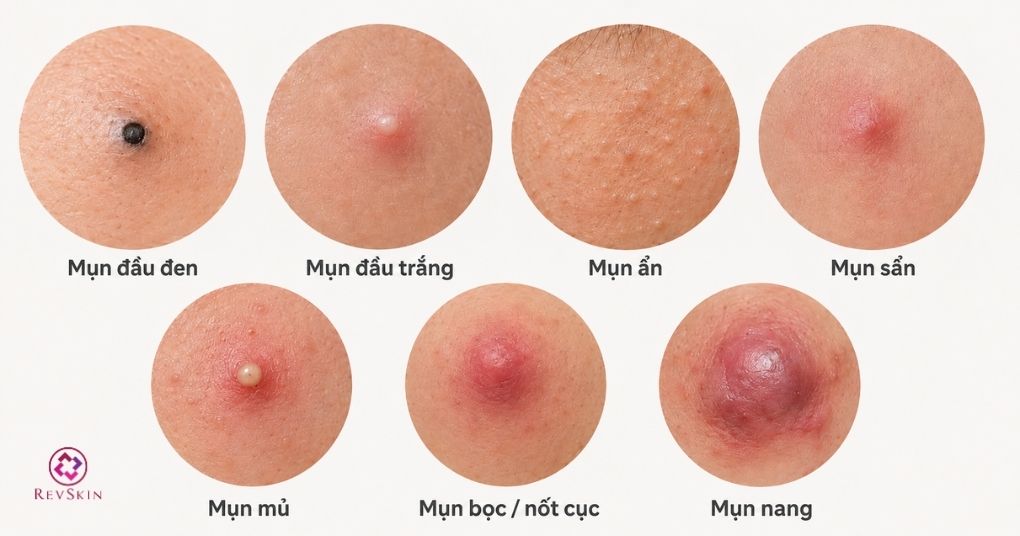 các loại mụn trứng cá tuổi dậy thì