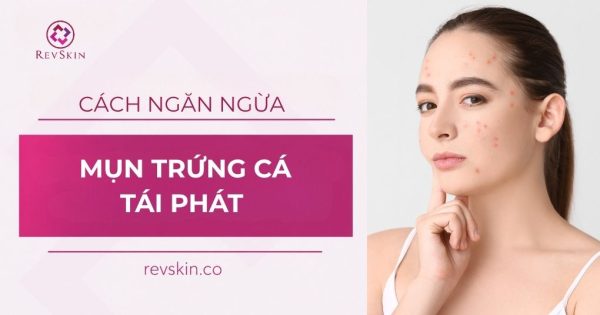 cách ngăn ngừa mụn trứng cá