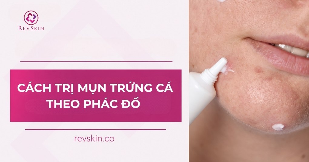 cách trị mụn trứng cá