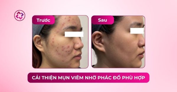 cải thiện mụn viêm phác đồ