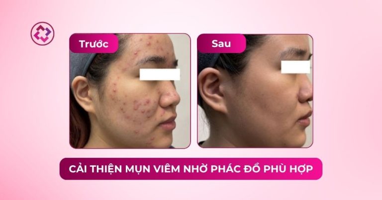 cải thiện mụn viêm phác đồ