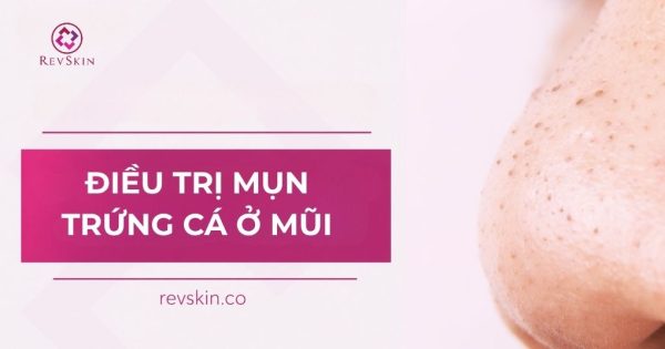 điều trị mụn trứng cá ở mũi