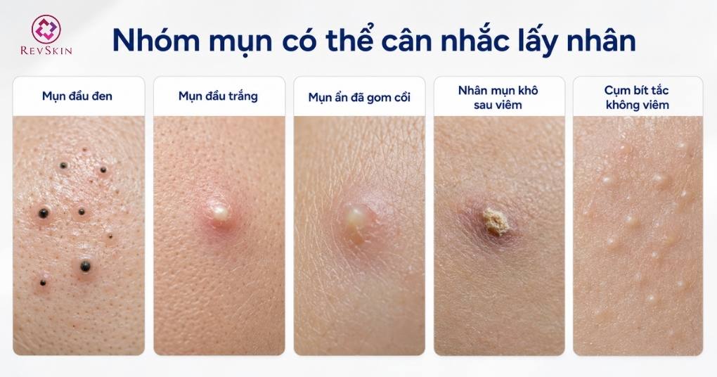 Phác đồ nặn mụn trứng cá chuẩn y khoa và biến chứng được phép nặn mụn