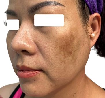 Hình ảnh trước điều trị