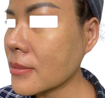 Hình ảnh sau điều trị