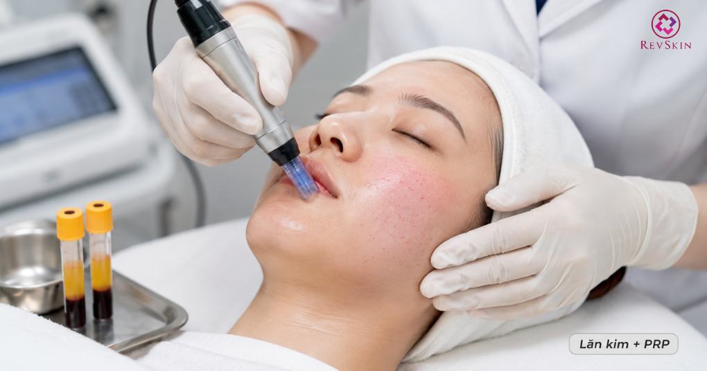 lăn kim kết hợp prp hỗ trợ phục hồi mô