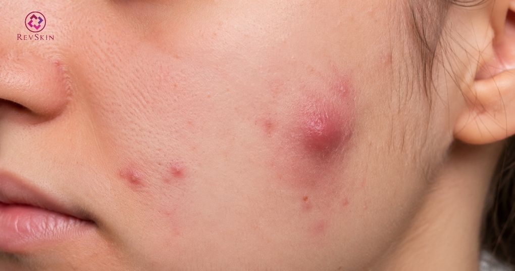 mụn bọc viêm sâu sưng đỏ
