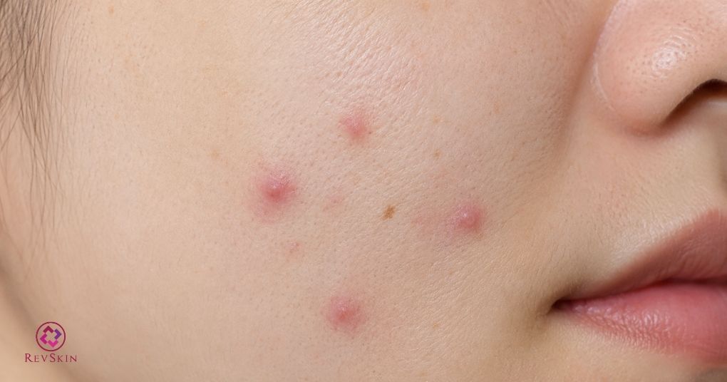 mụn sẩn đỏ viêm nhỏ