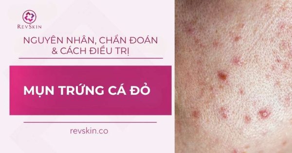 mụn trứng cá đỏ