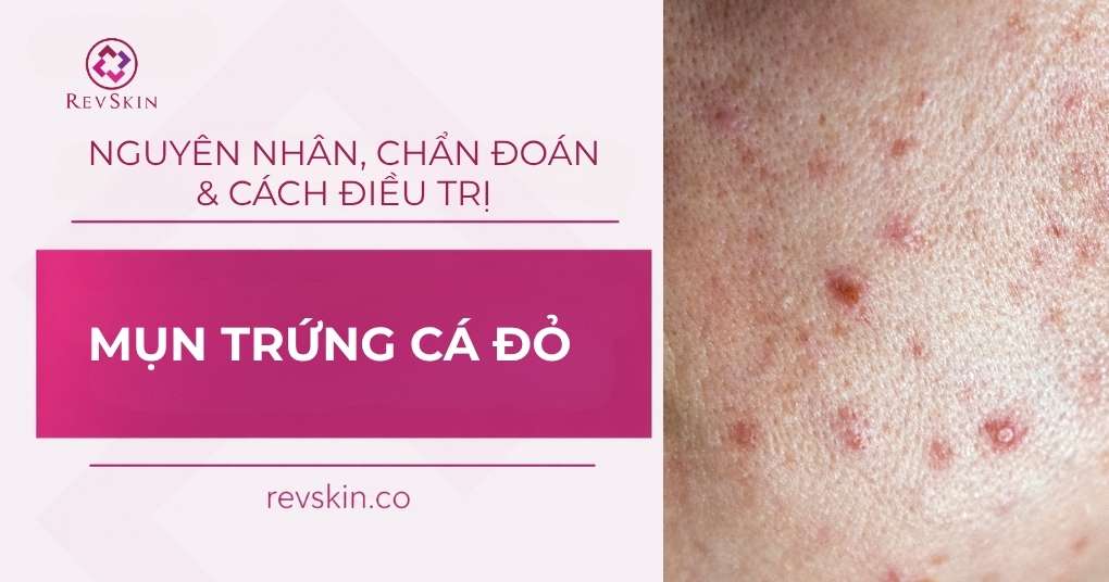 mụn trứng cá đỏ