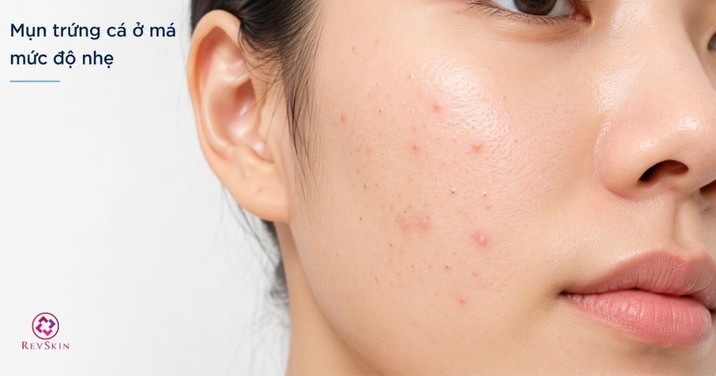 mụn trứng cá nhẹ