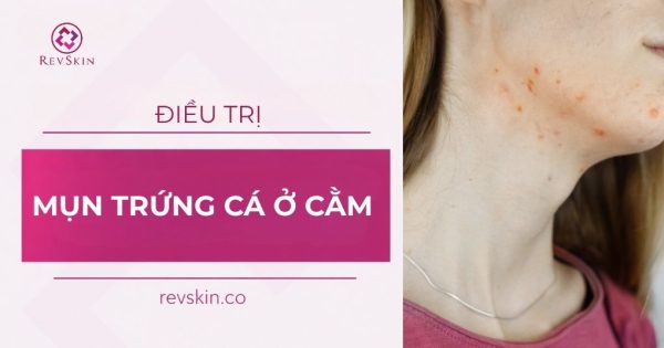 mụn trứng cá ở cằm