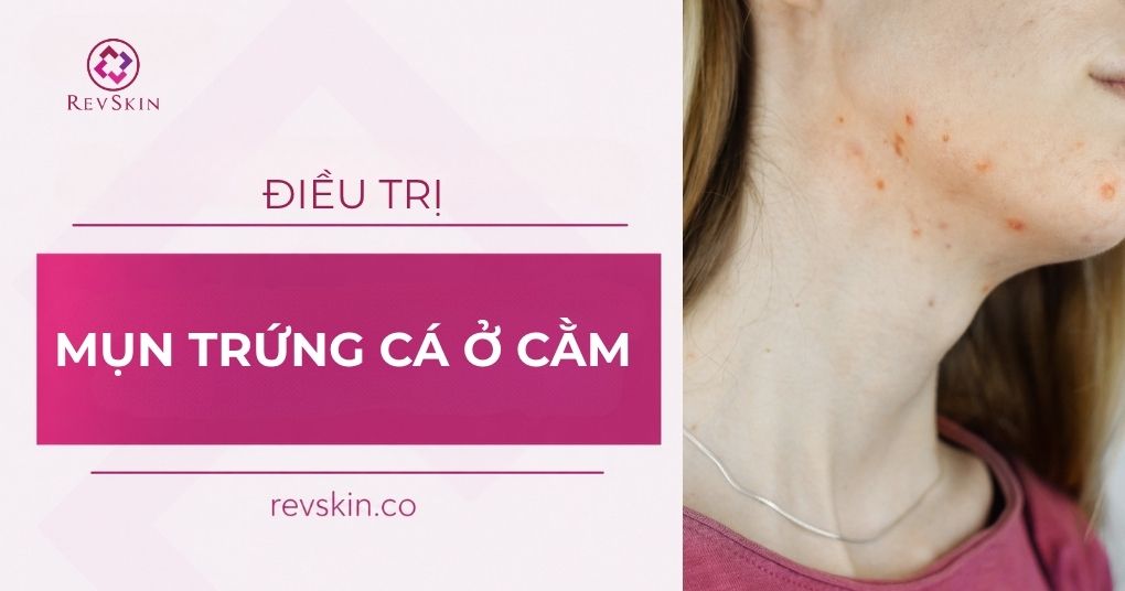 mụn trứng cá ở cằm