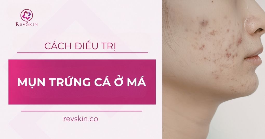 mụn trứng cá ở má