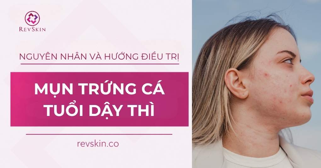 mụn trứng cá tuổi dậy thì