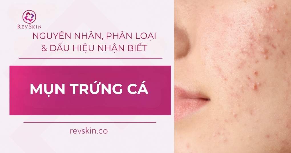 mụn trứng cá
