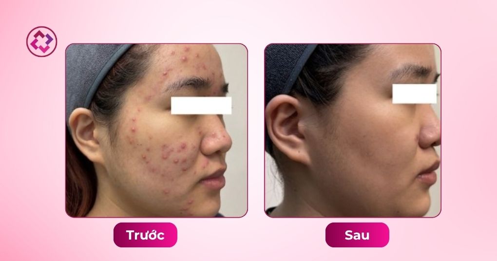 mụn viêm trước sau
